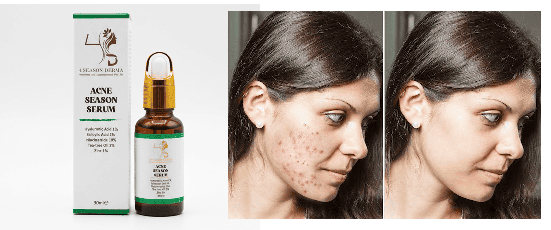 4 Season Derma promo